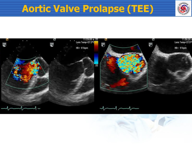 Aortic Valve Prolapse (TEE)